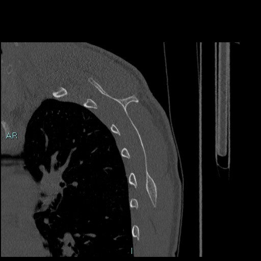Avascular necrosis after fracture dislocations of the proximal humerus (Radiopaedia 88078-104655 Sagittal bone window 69).jpg
