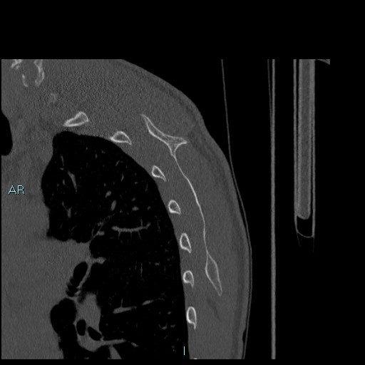 Avascular necrosis after fracture dislocations of the proximal humerus (Radiopaedia 88078-104655 Sagittal bone window 74).jpg