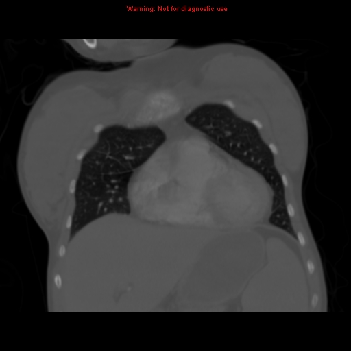 Avascular necrosis in sickle cell disease (Radiopaedia 17448-17152 Coronal bone window 34).jpg
