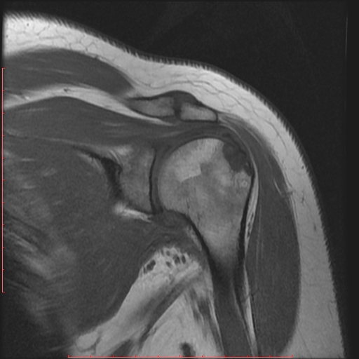 File:Avulsion fracture - greater tuberosity of humerus (Radiopaedia 25457-25703 Coronal T1 7).jpg