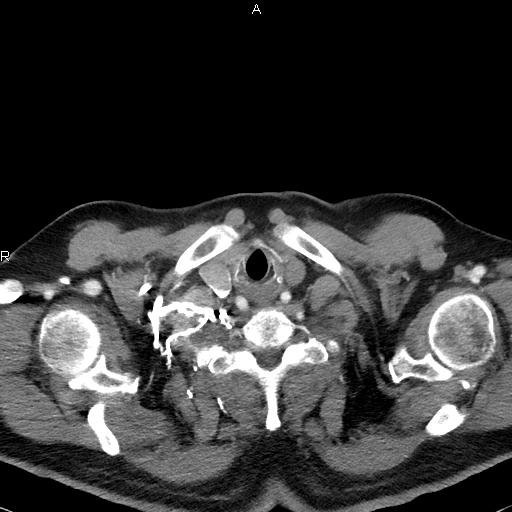 Azygos continuation of the inferior vena cava (Radiopaedia 18537-18404 C+ arterial phase 4).jpg