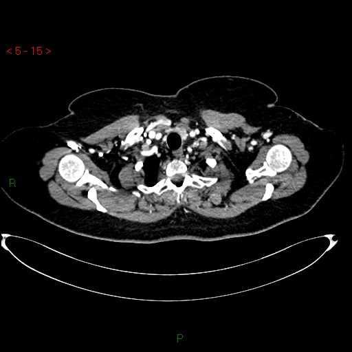 File:Azygos fissure and lobe (Radiopaedia 47620-52278 A 1).jpg