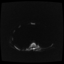 B cell lymphoma (Radiopaedia 56281-62954 Axial DWI 34).jpg