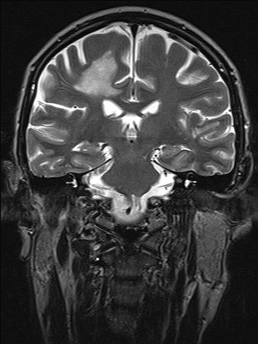 Balo concentric sclerosis (Radiopaedia 50458-55940 Coronal T2 31).jpg