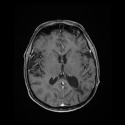 Balo concentric sclerosis (Radiopaedia 53875-59982 Axial LAVA C+ 143).jpg