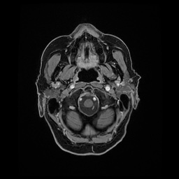 Balo concentric sclerosis (Radiopaedia 53875-59982 Axial LAVA C+ 26).jpg