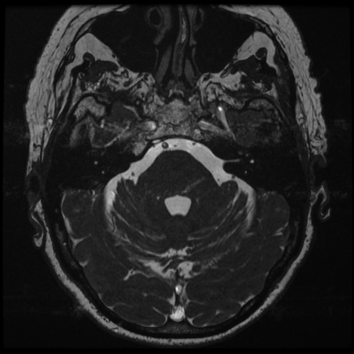 File:Balo concentric sclerosis (Radiopaedia 53875-59982 Axial T2 FIESTA 45).jpg