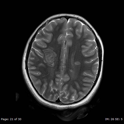 File:Balo concentric sclerosis (Radiopaedia 61637-69636 Axial T2 21).jpg