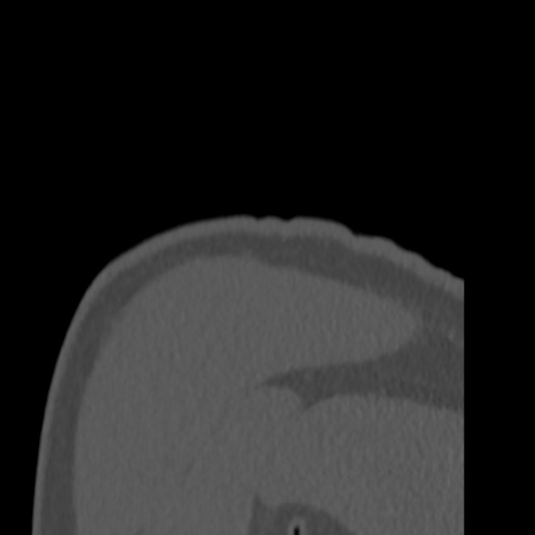 Bankart lesion (Radiopaedia 57256-64185 Coronal bone window 51).jpg
