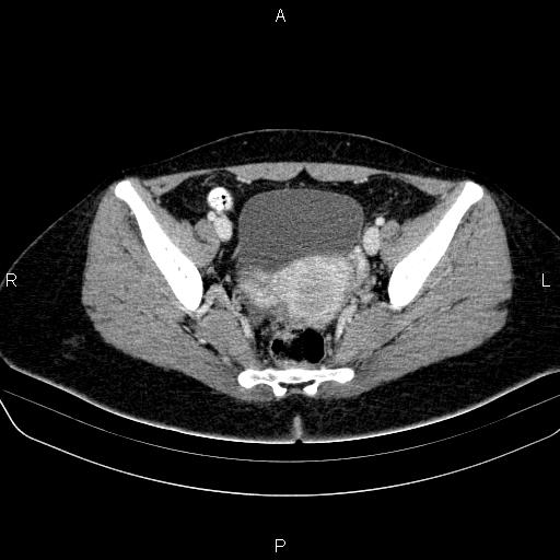 File:Bartholin gland cyst (Radiopaedia 62635-70930 Axial Post contrast 43).jpg