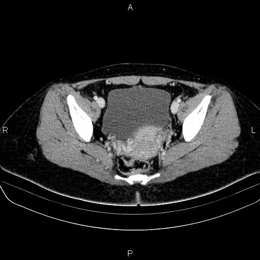 File:Bartholin gland cyst (Radiopaedia 62635-70930 Axial Post contrast 49).jpg