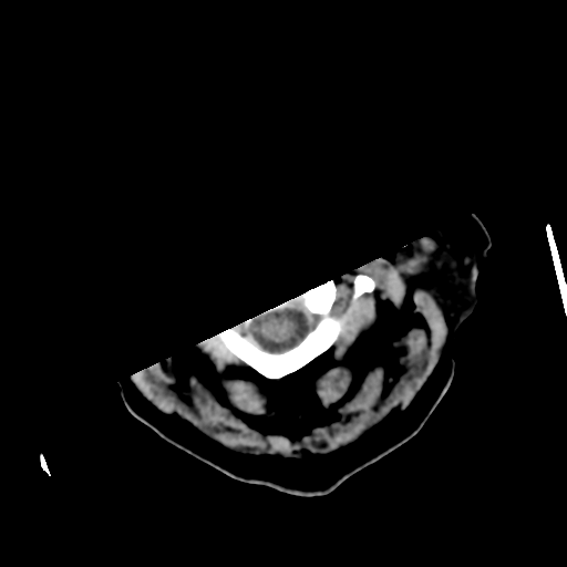 Basal ganglia metastasis (Radiopaedia 78928-91830 Axial non-contrast 6).png