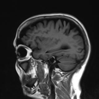 File:Base of skull chondrosarcoma (Radiopaedia 30410-31070 Sagittal T1 5).jpg