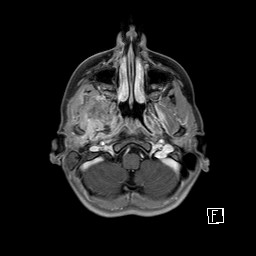 Base of skull rhabdomyosarcoma (Radiopaedia 32196-33142 T1 C+ fat sat 24).jpg