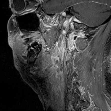 Base of tongue squamous cell carcinoma (Radiopaedia 31174-31884 F 54).jpg