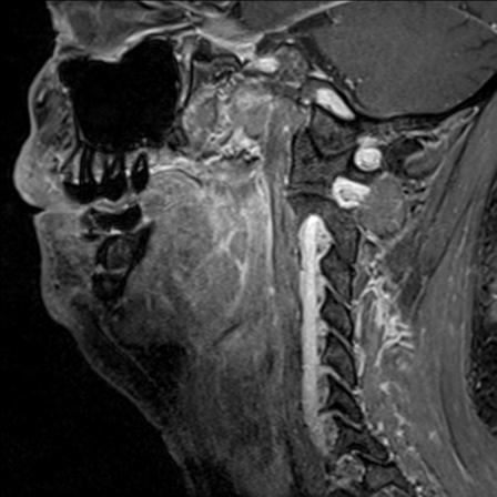 Base of tongue squamous cell carcinoma (Radiopaedia 31174-31884 F 65).jpg