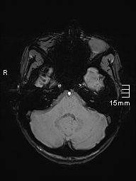 Basilar artery perforator aneurysm (Radiopaedia 82455-99523 Axial SWI 15).jpg