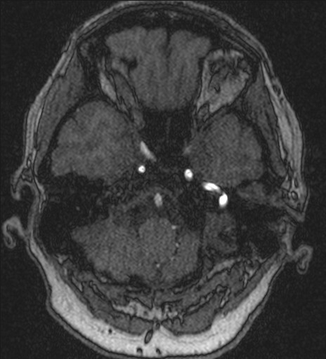 Basilar tip aneurysm (Radiopaedia 26504-26632 MRA 40).jpg