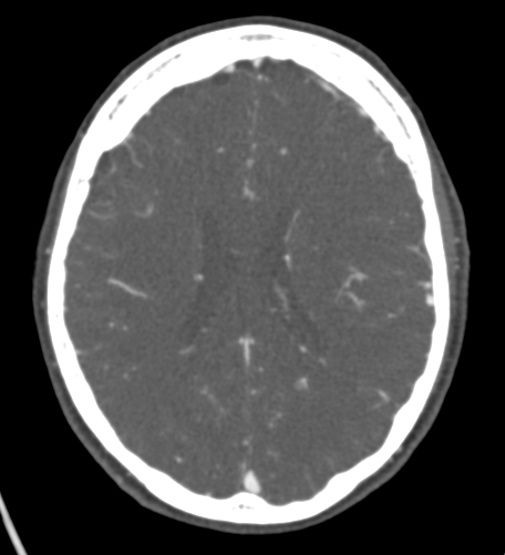 Basilar tip aneurysm with coiling (Radiopaedia 53912-60086 A 94).jpg