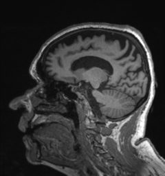 Behavioral variant frontotemporal dementia and late onset schizophrenia (Radiopaedia 52197-58083 Sagittal T1 36).png