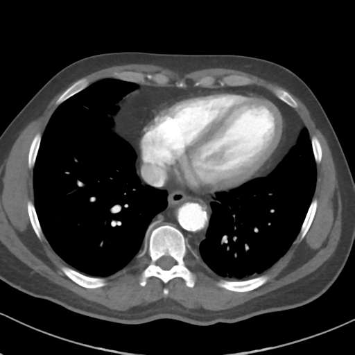 File:Behcet disease - aortitis (Radiopaedia 34359).png