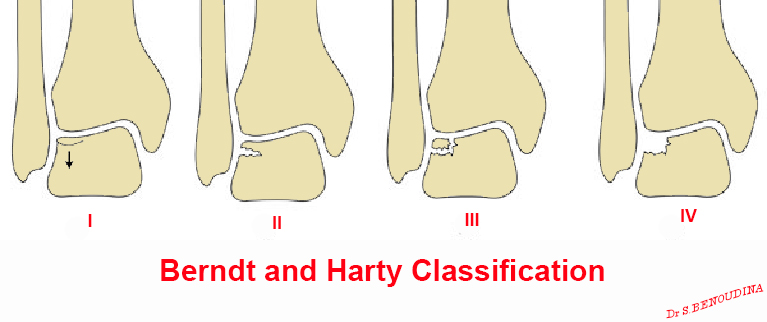File:Berndt and Harty classification (Radiopaedia 40786).jpg