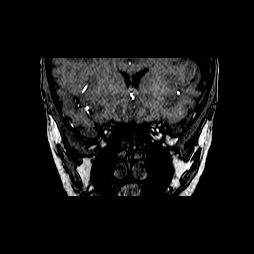 Berry aneurysm of the terminal internal carotid artery (Radiopaedia 88286-104918 Coronal TOF 21).jpg