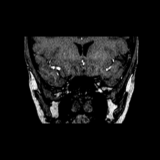 File:Berry aneurysm of the terminal internal carotid artery (Radiopaedia 88286-104918 Coronal TOF 24).jpg