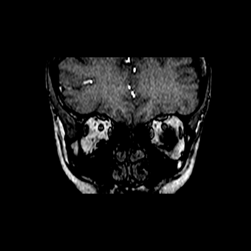 Berry aneurysm of the terminal internal carotid artery (Radiopaedia 88286-104918 Coronal TOF 6).jpg