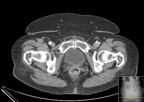 Bicameral celiacomesenteric aneurysm (Radiopaedia 55766-62327 A 72).jpg
