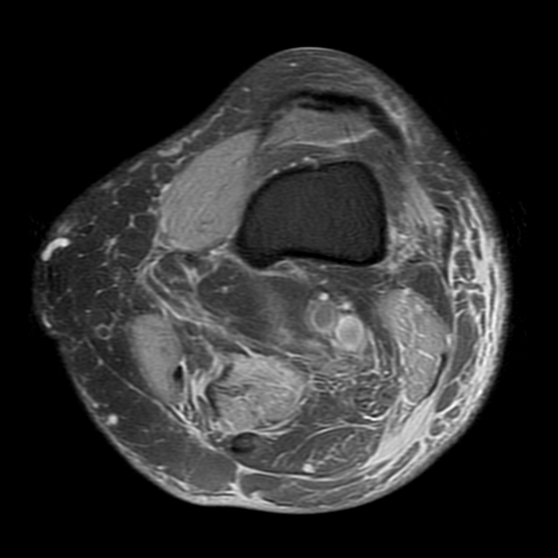 File:Biceps femoris distal tendon avulsion (Radiopaedia 15109-14987 Axial PD fat sat 2).jpg