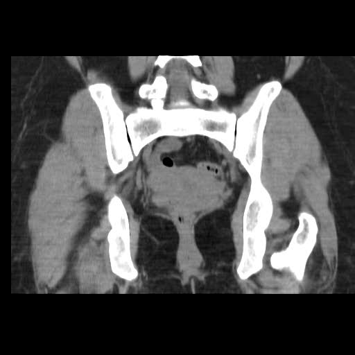 File:Bicornuate uterus- on MRI (Radiopaedia 49206-54296 Coronal non-contrast 15).jpg