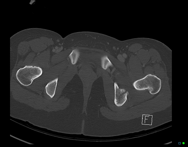 Bilateral acetabular fractures (Radiopaedia 79272-92308 Axial bone window 55).jpg