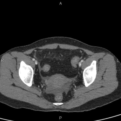 Bilateral adrenal gland hyperenhancement in pancreatitis (Radiopaedia 86642-102753 E 99).jpg