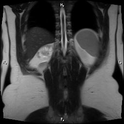 File:Bilateral adrenal myelolipoma (Radiopaedia 63058-71537 Coronal T2 3).jpg