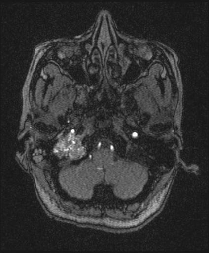 Bilateral carotid body tumors and right glomus jugulare tumor (Radiopaedia 20024-20060 Axial MRA 26).jpg