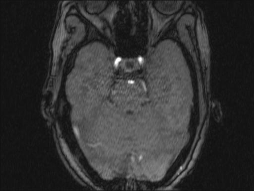 Bilateral carotid body tumors and right glomus jugulare tumor (Radiopaedia 20024-20060 Axial MRA 329).jpg
