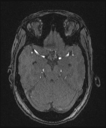 Bilateral carotid body tumors and right glomus jugulare tumor (Radiopaedia 20024-20060 Axial MRA 69).jpg
