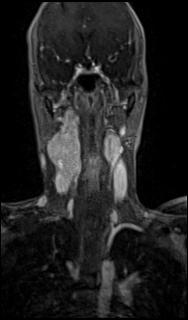 Bilateral carotid body tumors and right glomus jugulare tumor (Radiopaedia 20024-20060 MRA 27).jpg
