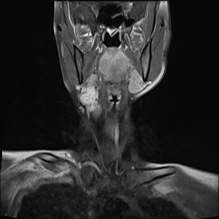 File:Bilateral carotid body tumors and right jugular paraganglioma (Radiopaedia 20024-20060 None 7).jpg