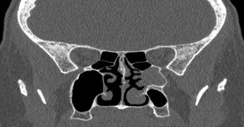 File:Bilateral ectopic infraorbital nerves (Radiopaedia 49006-54084 Coronal 15).png