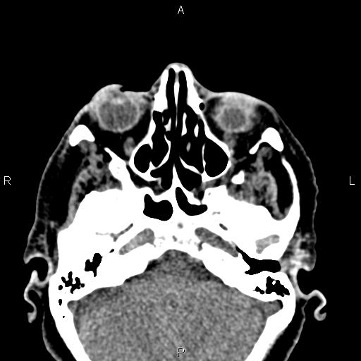 Bilateral enlargement of lacrimal glands - sarcoidosis (Radiopaedia 62627-70921 Axial non-contrast 30).jpg