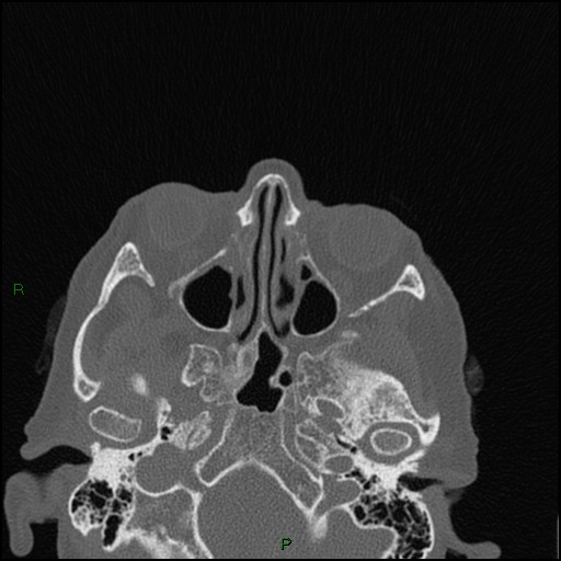 File:Bilateral frontal mucoceles (Radiopaedia 82352-96454 Axial bone window 167).jpg