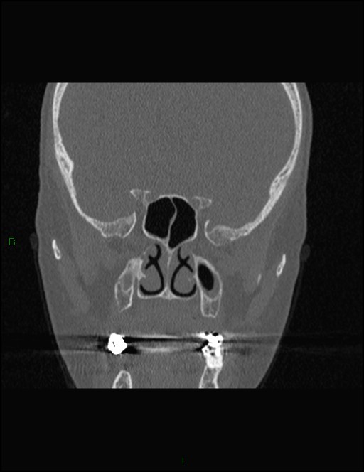 Bilateral frontal mucoceles (Radiopaedia 82352-96454 Coronal 193).jpg