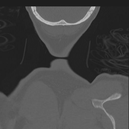 File:Bilateral locked facets (Radiopaedia 33850-35016 Coronal bone window 93).png
