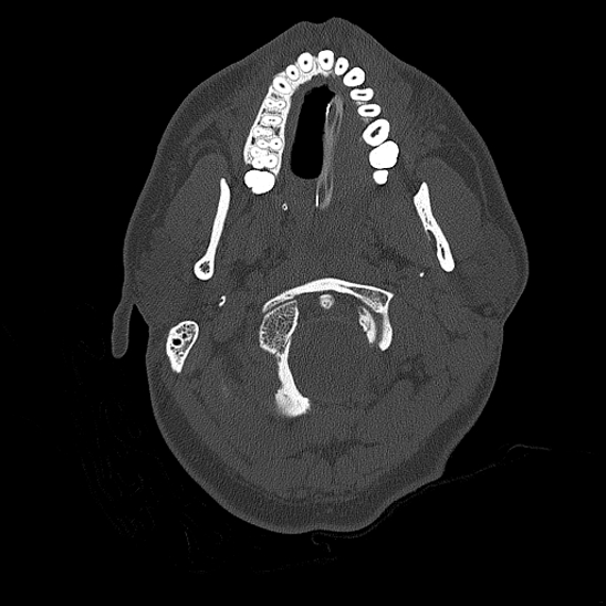 Bilateral occipital condyle fracture (type 2) (Radiopaedia 87675-104089 Axial bone thins 6).jpg