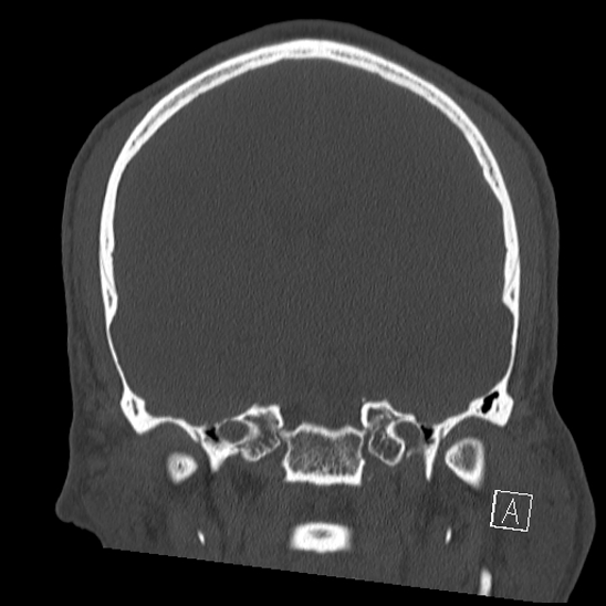 Bilateral occipital condyle fracture (type 2) (Radiopaedia 87675-104089 Coronal bone window 66).jpg