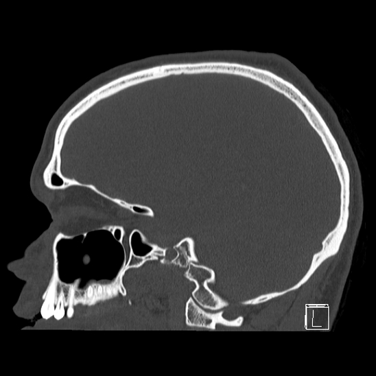 Bilateral occipital condyle fracture (type 2) (Radiopaedia 87675-104089 Sagittal bone window 71).jpg