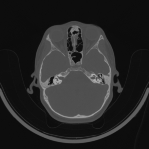 Bilateral otosclerosis (Radiopaedia 57237-64157 C 50).jpg