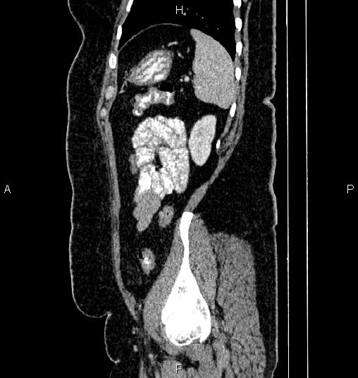 Bilateral ovarian dermoid cysts (Radiopaedia 85785-101603 D 77).jpg